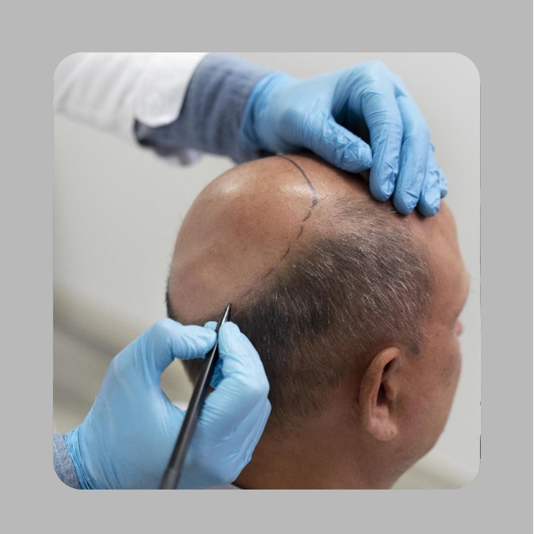 Techniques for Treating Alopecia, Hair Loss, and Hereditary Baldness
